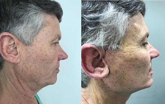 neck lift lima peru