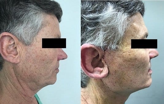 lifting de cuello lima