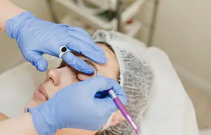 brow lift