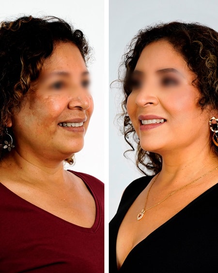 lifting facial deep plane