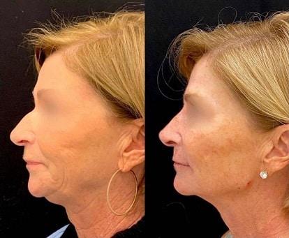 Lifting de cuello y lifting facial