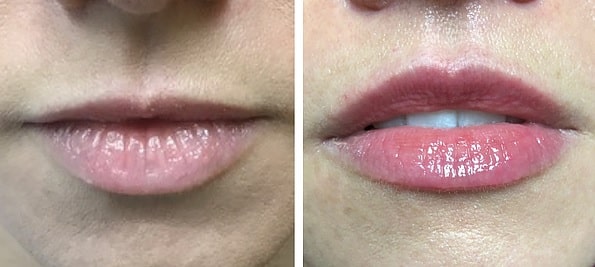 lip-lift-lima-peru