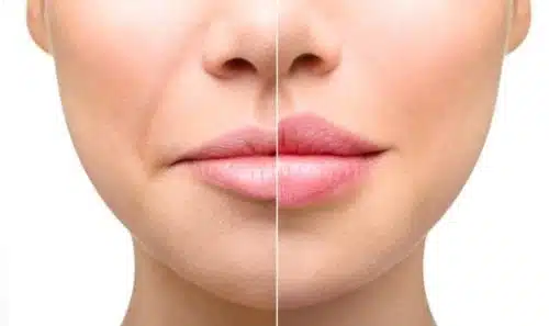 lip-lift-lima-peru