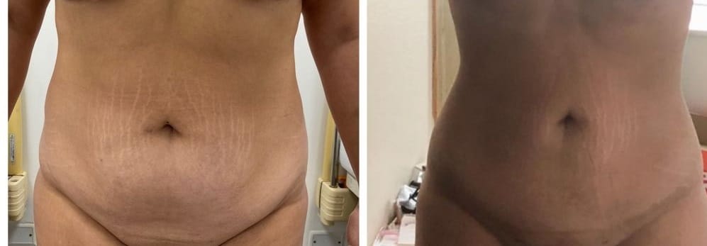 abdominoplastia extendida lima peru
