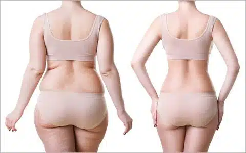 lipo 360
