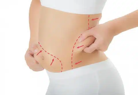 lipoescultura_lima myths facts liposuction