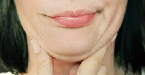double chin liposuction surgery