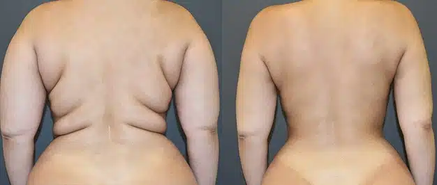liposucción en lima