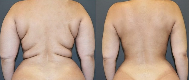 liposuction