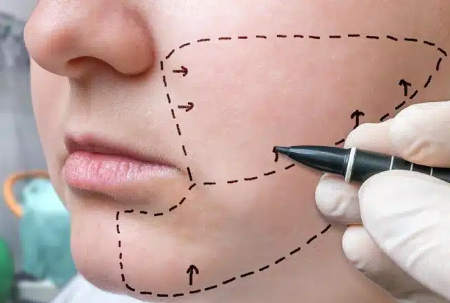 facial fat transfer
