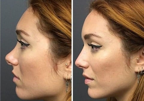 rinoplastia líquida