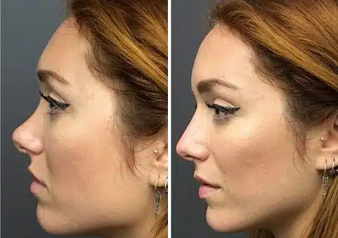 liquid rhinoplasty