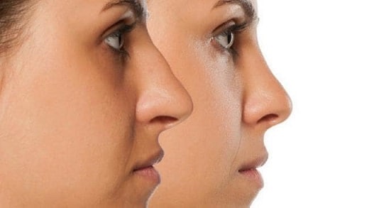 hyaluronic acid lima