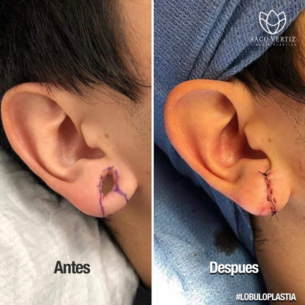 reparacion de lobulo