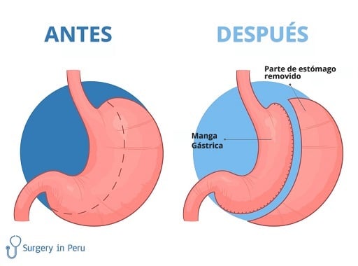 beneficios de la manga gastrica
