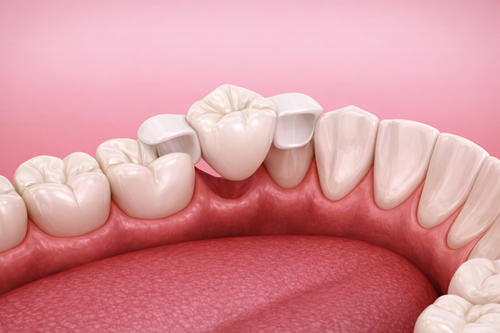 maryland bridge conservative dentistry