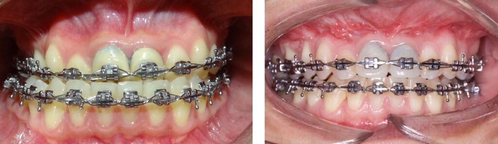 cirugía ortognatico maxilofacial