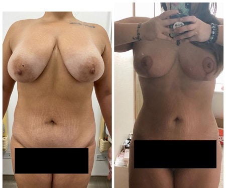 mommy makeover peru