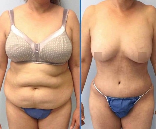 lipoabdominoplasty lima