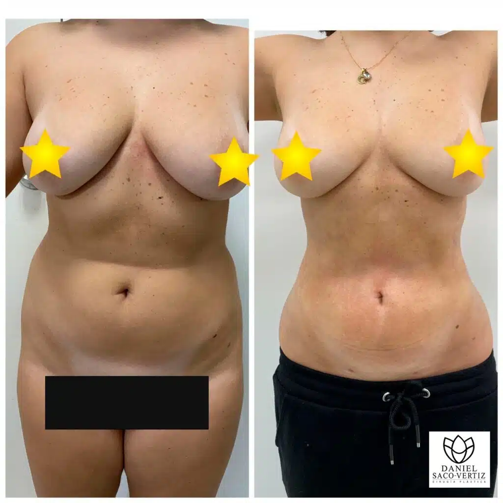 mommy makeover en Lima