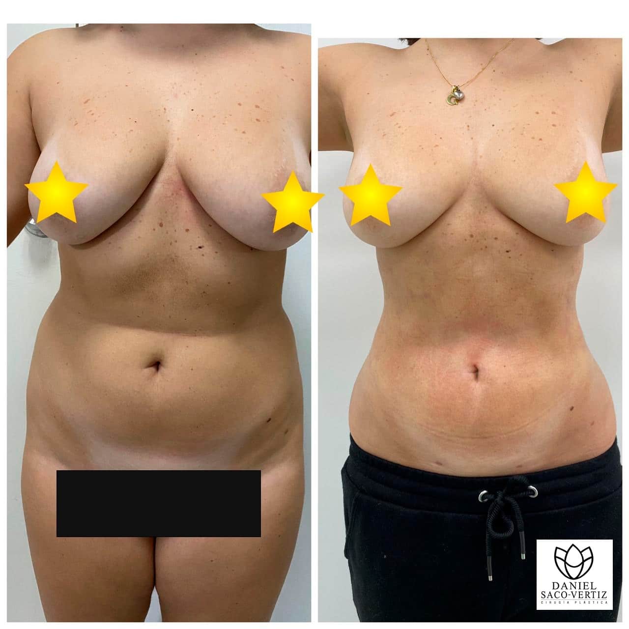 Abdominoplastia en Lima Peru