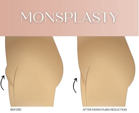 lifting de pubis, lipo de pubis