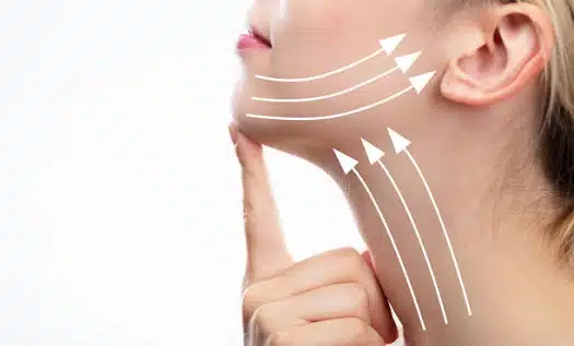 neck lift