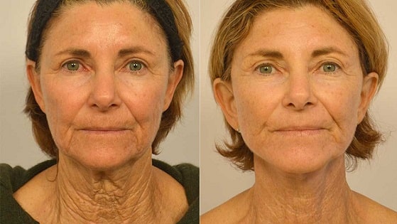 neck lift lima