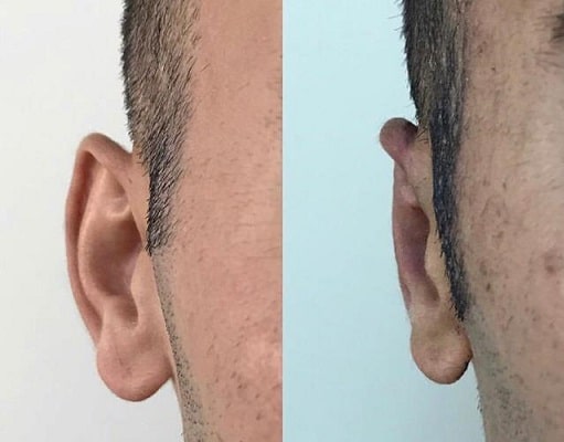 otoplasty lima peru