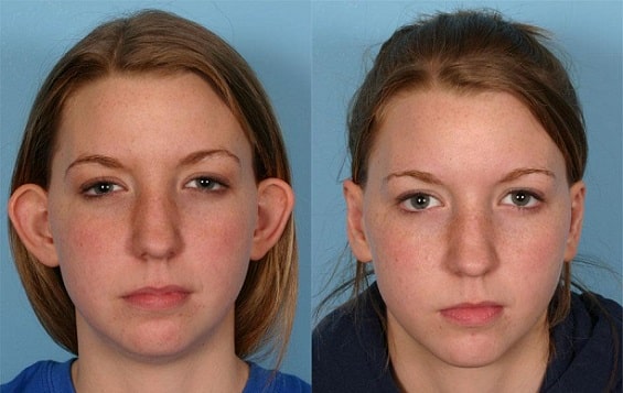 otoplasty lima