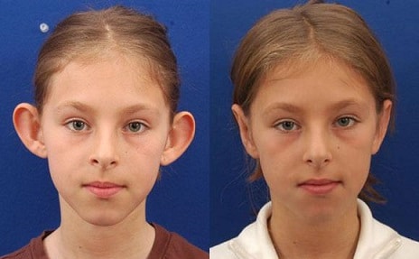 otoplasty lima
