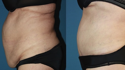 Panniculectomy lima