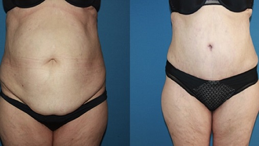 Panniculectomy