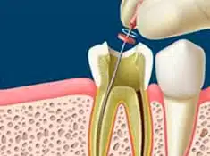 peru-root-canal-treatment