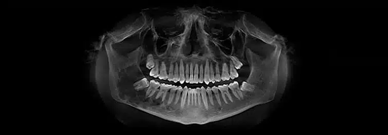 peru-wisdom-teeth-extractions