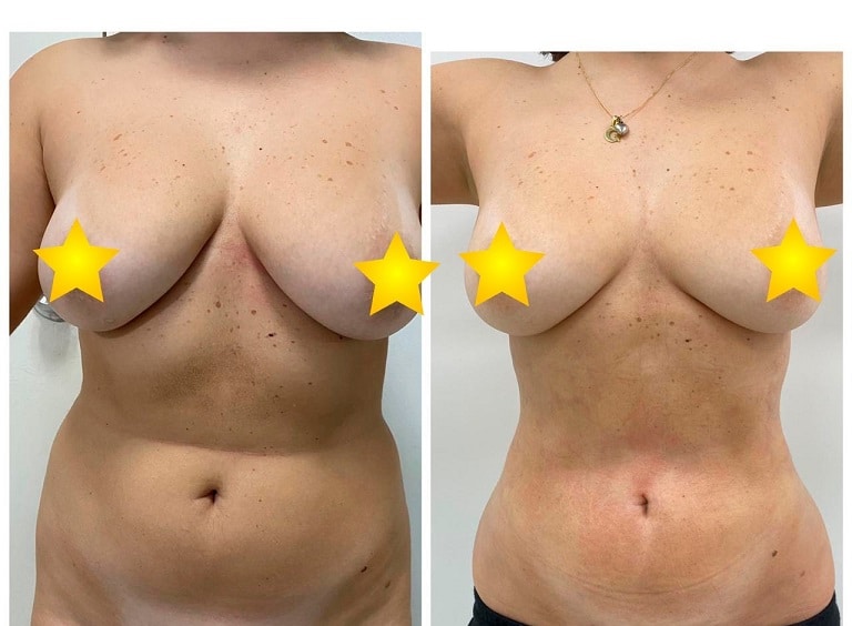 breast reduction