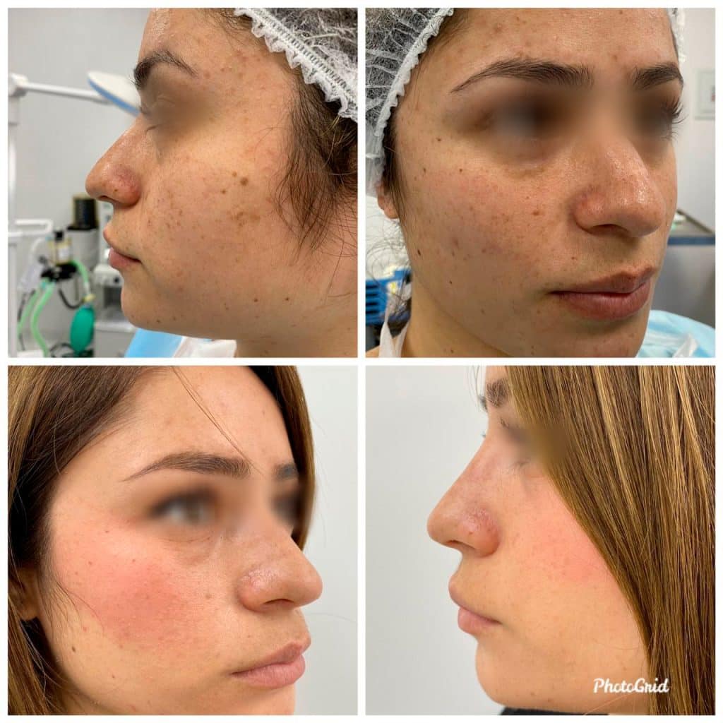 rinoplastia peru