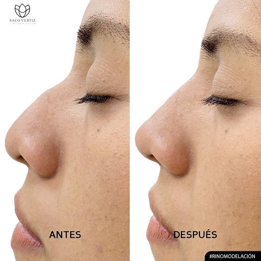 rinoplastia peru dr daniel sacovertiz