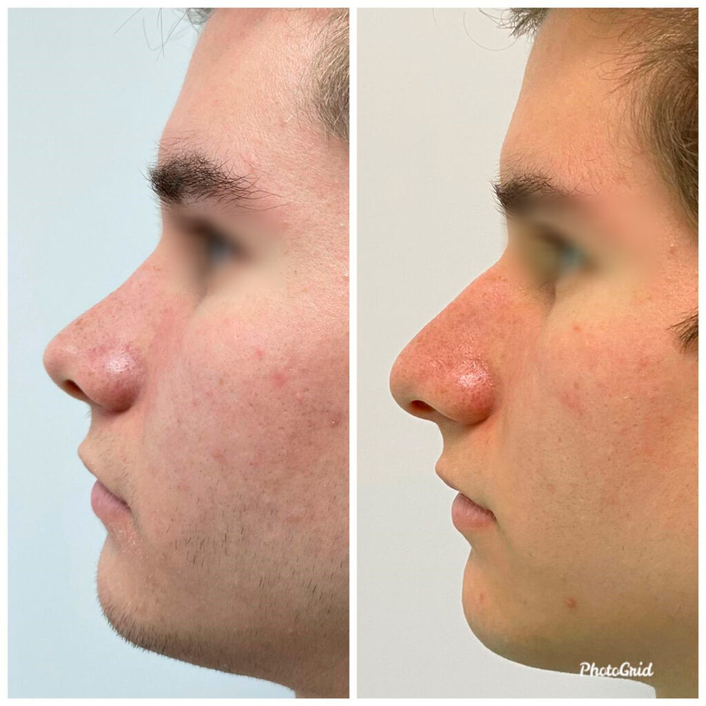 rhinoplasty in lima costs