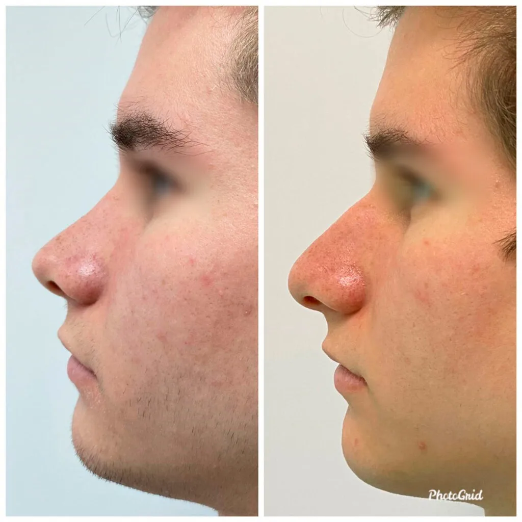 rhinoplasty in lima costs