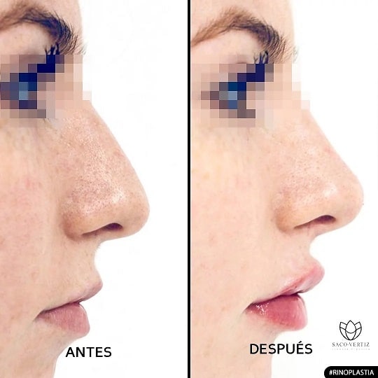 rinoplastia peru dr daniel sacovertiz