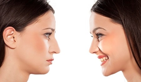 rhinoplasty peru