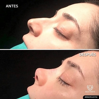 cirugía plástica facial