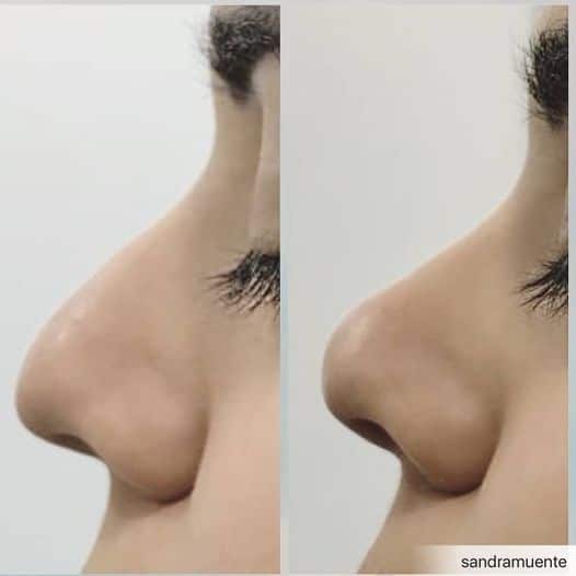 rinoplastia peru