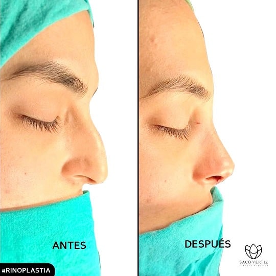 rinoplastia lima peru