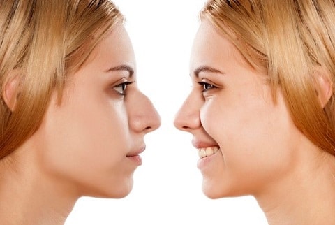 rhinoplasty risks