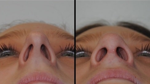 rinoseptoplastia