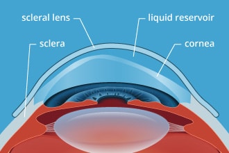 scleral lens