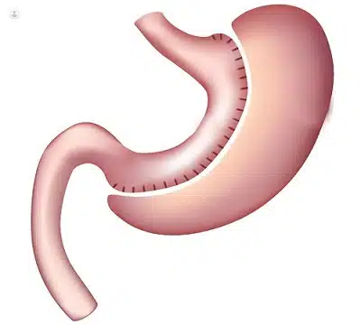 sleeve gastrectomy