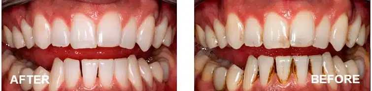surgical-peru-teeth-whitening